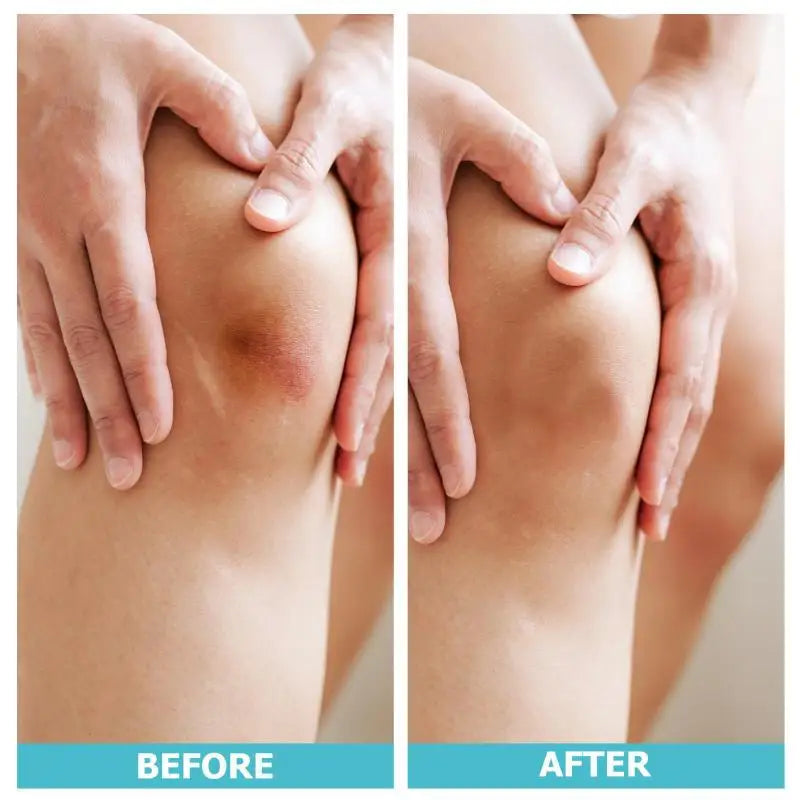 Hydrocolloid Bandage Roll; Waterproof Extra Thin Dressing for Exceptional Wound Care; Self Adhesive Scar Tape